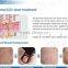 Skin Renewing RF Tube Fractional CO2 Birth Mark Removal Laser Vaginal Tightening And Rejuvenation Machine