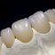 Dental Porcelain Gold Crown/Precious metal Crown China Outsourcing Dental Lab