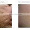 Professional 3 Handles IPL Vascular Vein Treatment/ Acne Scar Removal IPL/ IPL Hair Removal