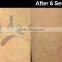 532nm Professional Q Switched Nd Naevus Of Ito Removal Yag Laser Tattoo Removal Machine 1 HZ
