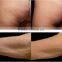 rf frequency combine with cooling system/fractional rf wrinkle removal/face lifting
