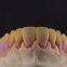 PFM-Bridges-Crowns  China Dental Laboratory - Outsourcing Dental Lab