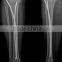 Titanium elastic nail orthopedic implants