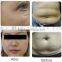 Perfect slimming system Apolomed HS-520RV cavitation ultrasonic