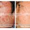 deep wrinkle reduction skin rejuvenation acne treatment LED light physical phototherapy lamp