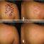 hottest nd yag laser treatment medical device for birthmark removal