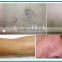 laser for spider vein removal high frequency machine beijing fogool