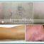 Painless Vascular Therapy Face Vein Removal For Vascular Removal beijing fogool