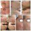 IPL SHR laser mole removal machine / wholesale distributors wanted SHR laser depilation facial machine