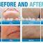Permanent all body unwanted Hair Remover 808nm diode laser portable equipment