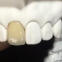 Anterior PFZ And Posterior Crowns Zirconia Accepting International Dental