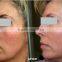 Beautician use Nd Yag Laser tattoo removal laser for sale