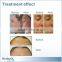 Hydro Dermabrasion Machine Portable Facial Machine Skin Breeze Microdermabrasion Diamond Skin Scrubber And Water Peel Tips Oxygen Spray Beauty Machine