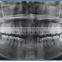 Digital Radiography System Panoramic Machine