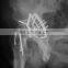 Orthopedic Acetabulum Posterior Wall TiNi SMA Guidance Fixater