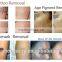 Haemangioma Treatment New Designed Q Switch Nd Yag Laser 1 HZ Tattoo Removal Machine Price/ Tattoo Removal Laser For Sale