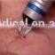 30MHz portable laser for vascular/spider vein removal machine