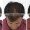 Hair loss treatment hair regrowth machine/diode laser hair regrowth machine to salon