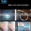 Laser Spider Vein Removal 15W High Power / Vascular Removal / Blood Vessel Removal