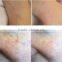 laser beauty equipment SDL-G model 980nm diode laser vascular removal