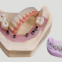 Implant Crowns & Bridges