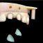 Digital-Crowns-Bridges Chinese Dental Lab Denture