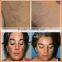Laser Vascular Therapy Red Spider Veins Removal Machine /Removal of spider veins