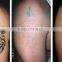Permanent Tattoo Removal Long Pulse Nd Yag Laser Hair 1-10Hz Removal Machine/nd Yag Laser Machine Prices