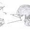 Orthopedic Acetabulum Posterior Wall TiNi SMA Guidance Fixater