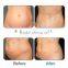 Slim freezer plates weight loss lipocryo fat freezing device