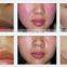 New Style Portable Hair Removal OPT IPL SHR Laser Fast Hair Removal+elight+ RF +laser Machine