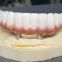 All On 4 Implant in China Outsourcing Dental Lab