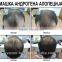 Efffective solutions for hair loss in women