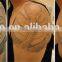 laser tattoo removal equipment q-switch nd yag laser