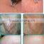 980nm diode laser permanent vascular removal/980nm diode laser vein stopper machine