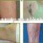 The 2015 professional 808nm diode laser hair removal machine for dermatologist with remarkable results