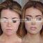 Freckle moles removal laser pen face spots removal the new 2015