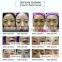 Mini needle free mesotherapy RF facial lifting hifu anti-wrinkle anti-aging skin care device