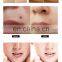 Dual plasma pen wrinkle removal skin rejuvenation salon use plasma device for sale