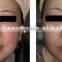 AYJ-T02 (CE)Skin rejuvenation E Light Medical Beauty Device Used in Clinic and Spa