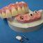 Implant retention stabilizes denture Bar Overdenture on Implant