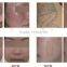 Q-Switch ND:Yag Laser Melasma/Cloasma And Nevus Of Ota Removal