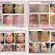 2016 The most popular at home use laser hair removal IPL surgical treatment for beauty spa and clinic