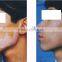 Epidermis Transplantation Vitiligo Machine
