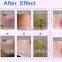 F7 vertical best home rf skin tightening face lifting machine