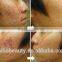 Best Price RF Tube Co2 Fractional Laser/co2 Laser 40w Cutting Machine/laser Acne Removal/laser Scar Removal Machine Warts Removal