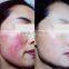 Big Discount! Top Quality Laser Spider Vein Machine / Skin Tag Removal Machine on Sale