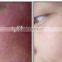 980nm diode laser vascular removal machie/spider vein removal device