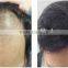 Bald Head Treatment Hair Building clinic treatment Bald Head Hair Growth Fiber