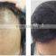 SH650-1diode laser hair transplant equipment for hair extension